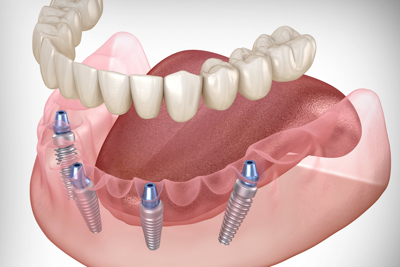 Denture Implants Snap on Fixed Mansfield Mansfield Oral Surgery