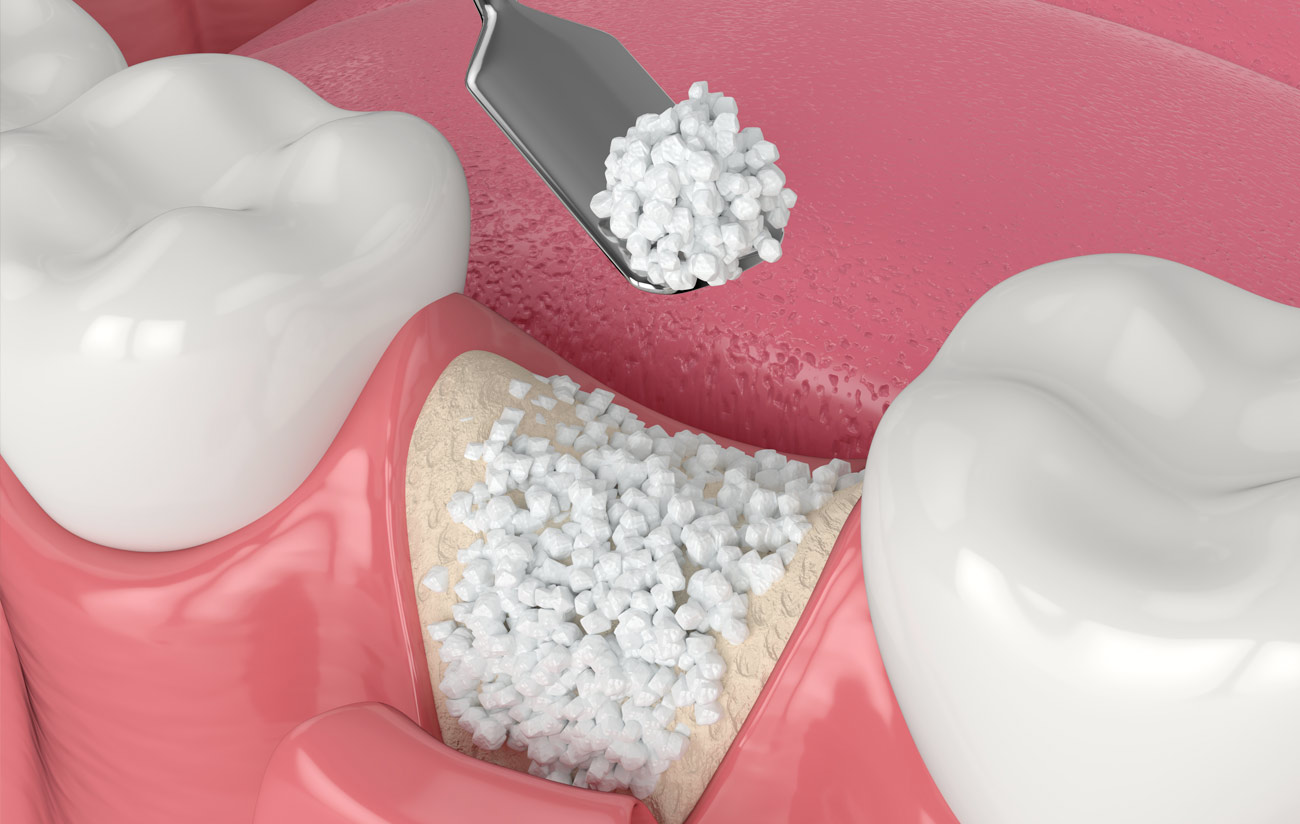 3D render of dental bone grafting with bone biomaterial application