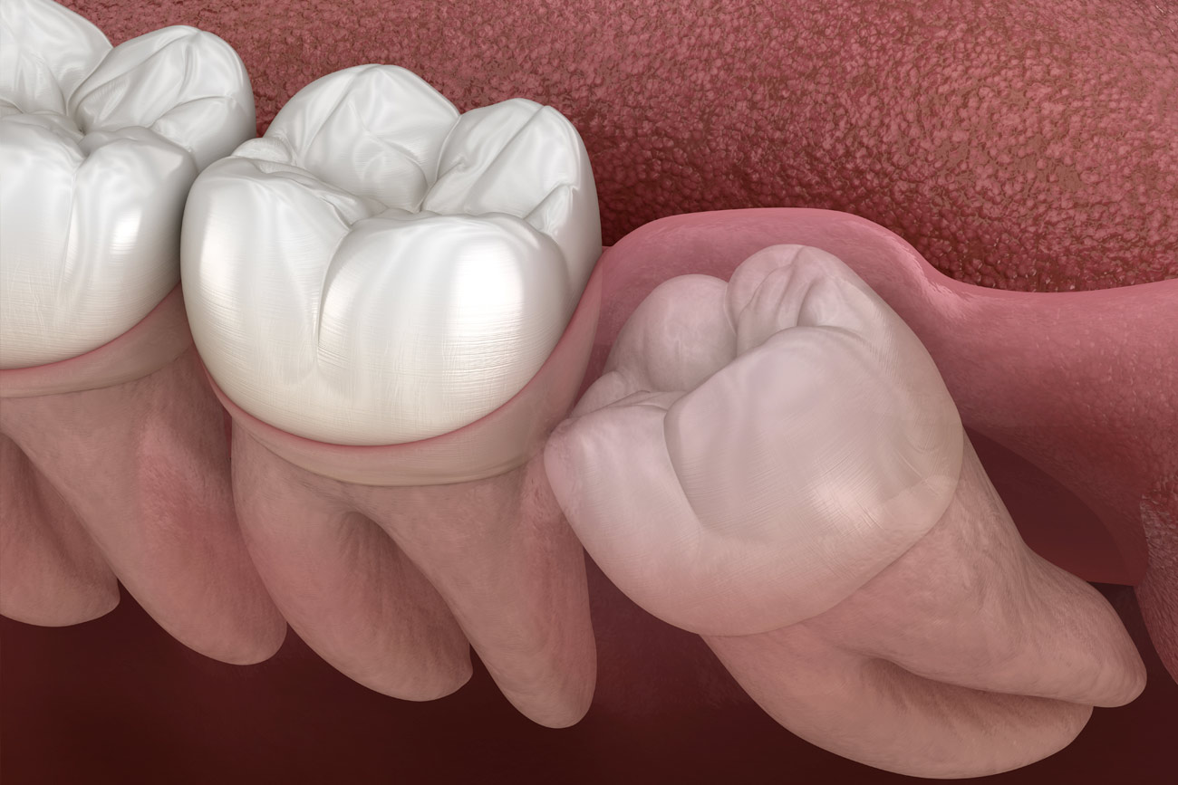 Wisdom tooth removal