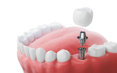 The Benefits of Choosing Dental Implants Over Dentures
