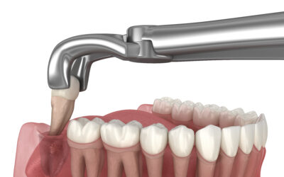 5 Telltale Signs When to Seek Attention for Your Wisdom Tooth